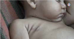Es común ver el mismo cuadro de enfermedades de la piel en decenas de niños de comunidades empobrecidas en Maracaibo, Venezuela..