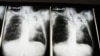 FILE - X-rays of a tuberculosis patient at A. G. Holley Hospital in Lantana, Florida.