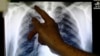 OMS: nuevo tratamiento oral contra la tuberculosis