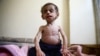 Two-and-a-half year old Hala al-Nufi, who suffers from a metabolic disorder which is worsening due to the siege and food shortages in the eastern Ghouta, reacts as she sits on a bed in the Saqba area, in the eastern Damascus suburb of Ghouta, Syria.