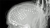 This is an X-ray showing electrodes that surgeons use to find and remove the source of seizures (to cure epilepsy), while sparing the source of mental functions like language. This image relates to an article that appeared in the October 16, 2009, issue o