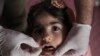 Vacuna inyectable para erradicar polio